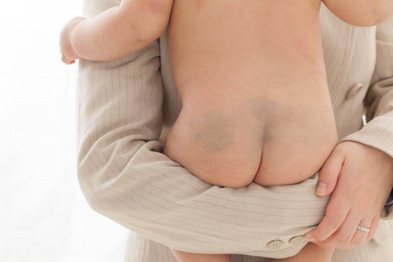 赤ちゃんのおしりの蒙古斑の原因は？